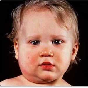Паротит в бебето: симптоми, които помагат да се разпознае болестта