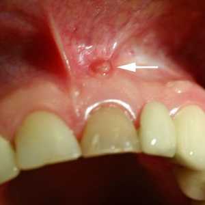 Фистула на венците: причини и методи на лечение. Какво е опасно за фистулата на венците