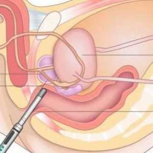 Трансректален ултразвук на простатата: описание, подготовка и препоръки