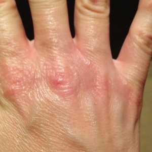 Крекинг кожата на пръстите: причини, лечение