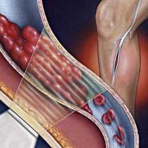 Тромбоемболизъм на долните крайници: възможни причини, симптоми и характеристики на лечението