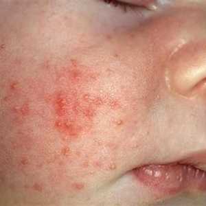 Дали детето има изпотяване или алергия? Как да разграничаваме.