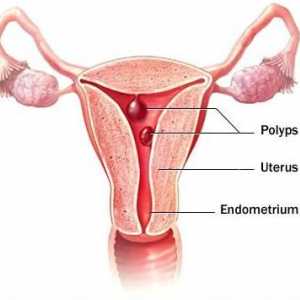 Отстраняване на полипа в матката: прегледи. Следоперативен период