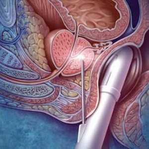 Премахване на простатата: последици от операцията, прегледи