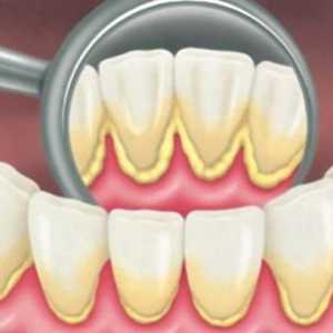 Отстраняване на плаки: професионално почистване на зъбите