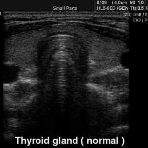 Ултразвукът на щитовидната жлеза е нормален. Размерът на щитовидната жлеза е нормален. Индикатори…