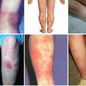 Нодуларен еритем по краката: симптоми, причини, лечение