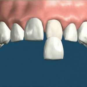 Фурнир върху зъби: предимства на елемента, характеристики на неговата инсталация и указания за…