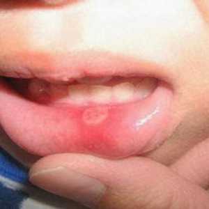 В устата пъпчето: причини и методи на лечение