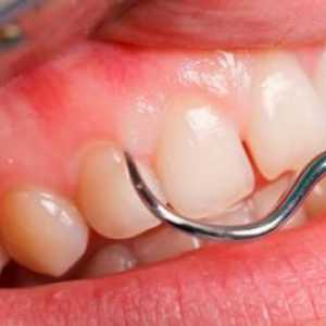 Възпаление на венците близо до зъба на мъдростта. Как да облекчим гингивита у дома