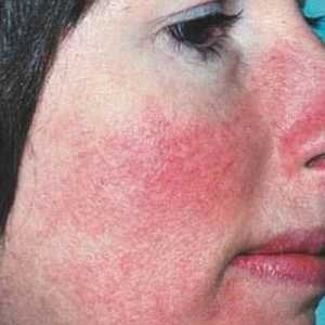 Възпаление на кожата на лицето: причини, видове, превенция и лечение