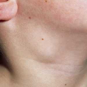 Възпаление на лимфните възли в гърлото при дете: причини и лечение