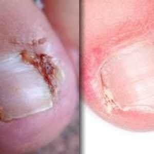 Отглеждане на ноктите на крака: причини за появата и лечението