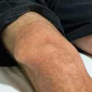 Разместване на колянната става: основни симптоми, лечение