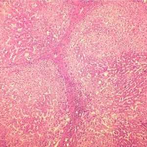 Болест на чернодробна цироза: колко живеят с нея