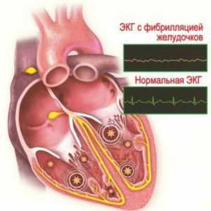 Вентрикуларната аритмия на сърцето: симптоми и лечение