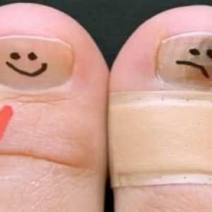 Нездравословна гъба по ноктите на краката: лечение с народни средства