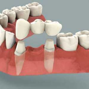 Зъбният мост: рецензии. Монтаж на стоматологичен мост